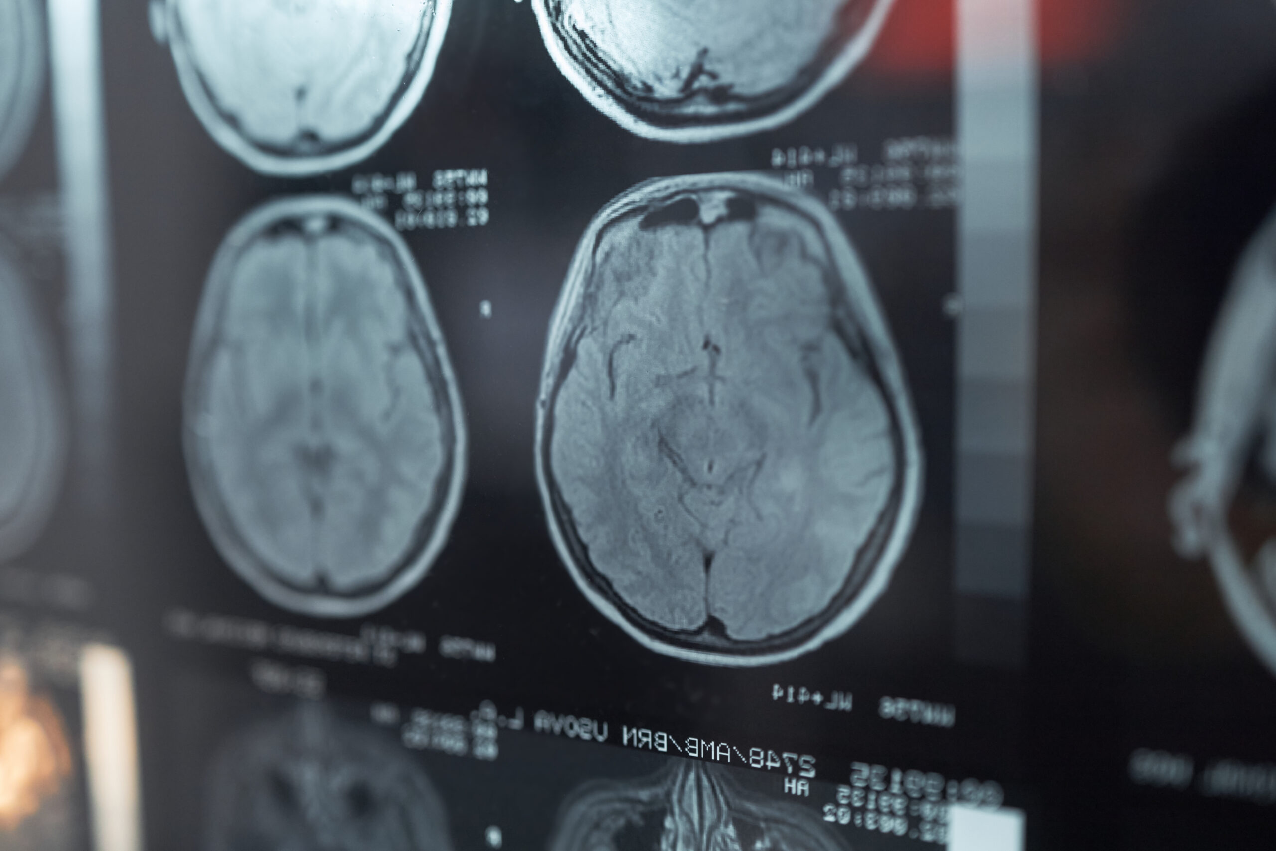 Close up of brain MRI scans displaying diagnostic imaging for neurological examination and clinical analysis. Useful for healthcare marketing, radiology, neurology, or hospital content